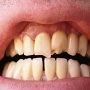 Rokers en drinkers hebben drie keer meer kans op orale gezondheidsproblemen